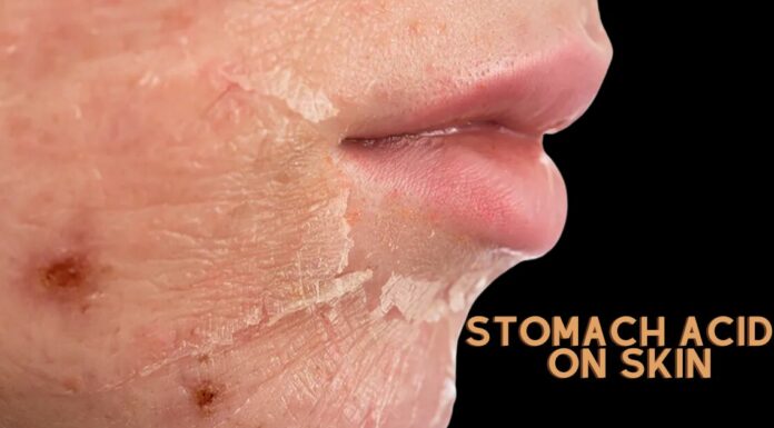 Understanding Stomach Acid Burns on Skin:  Causes & Treatment Stomach-Acid-Burns-on-Skin
